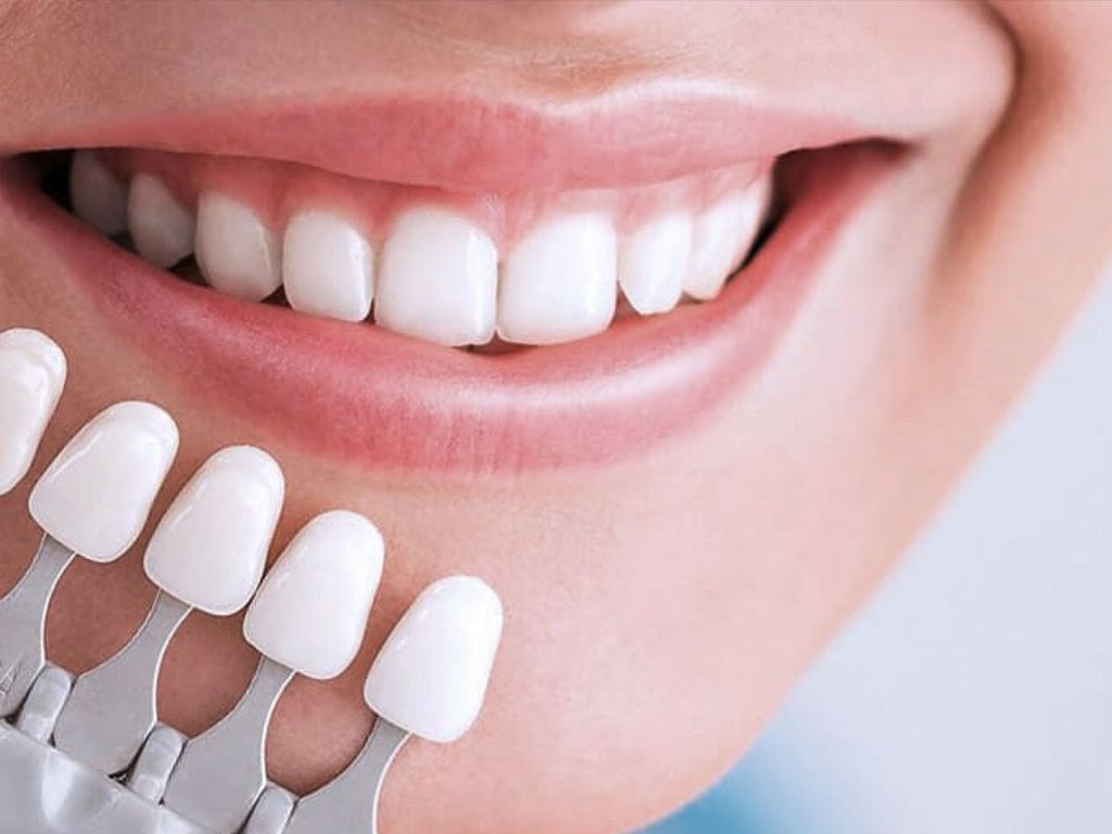 لمینت یا کمپوزیت؛ کدامیک بهتر است؟ لمینت یا کمپوزیت؛ کدامیک بهتر است؟