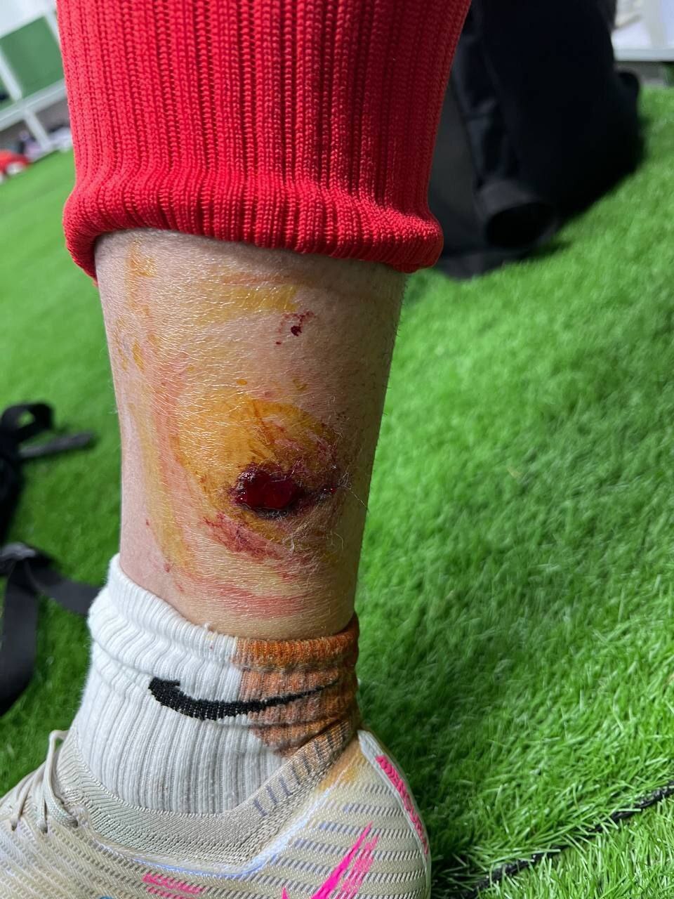 پرتاب نارنجک در اراک یک پرسپولیسی را مصدوم کرد + عکس