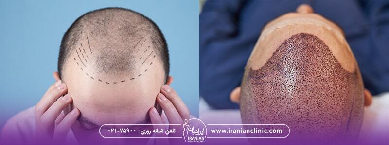 مراقبت های بعد از کاشت مو چیست؟ مراقبت های بعد از کاشت مو چیست؟