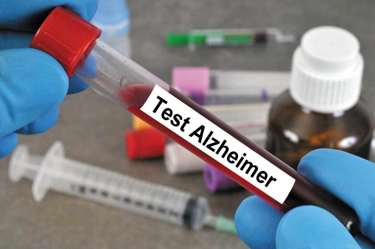 بیماری آلزایمر با آزمایش خون قابل تشخیص است