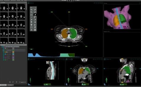 درمان سرطان های شایع با شتابدهنده خطی ساخت ایران/ سرطان با شتابدهنده خطی ایرانی قابل درمان است!