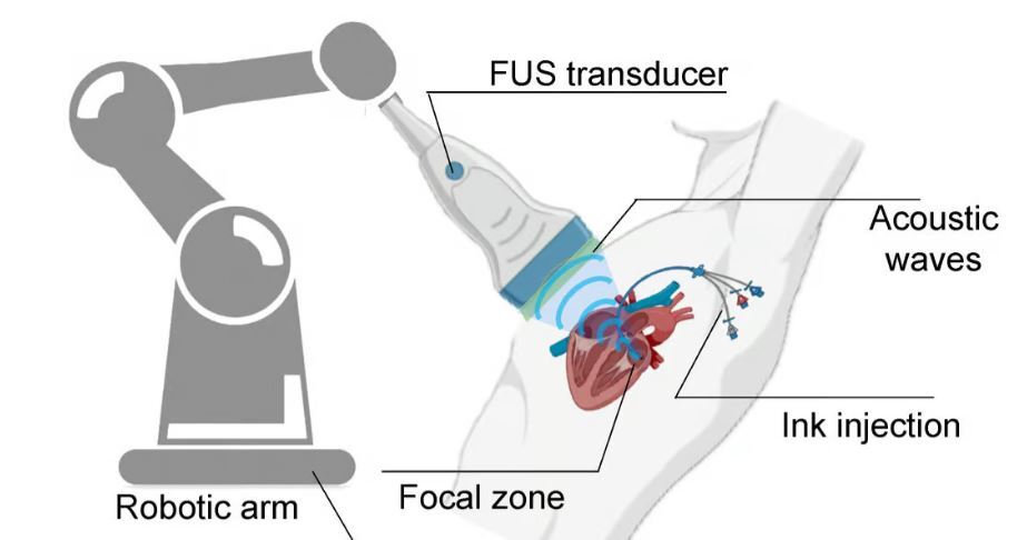 تکنولوژی جدید سونوگرافی می تواند برای ایمپلنت های سه بعدی در داخل بدن استفاده شود