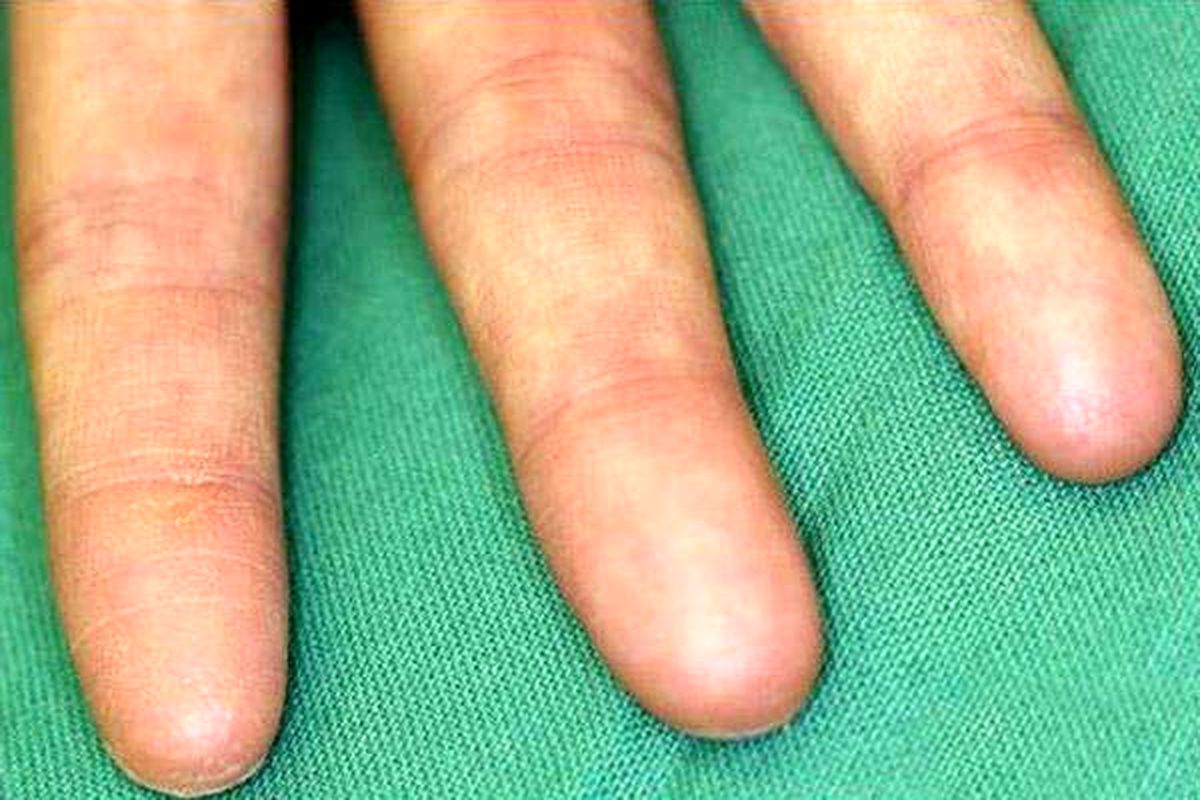 اگر انگشتانتان سرد است به این بیماری خاص دچارید!