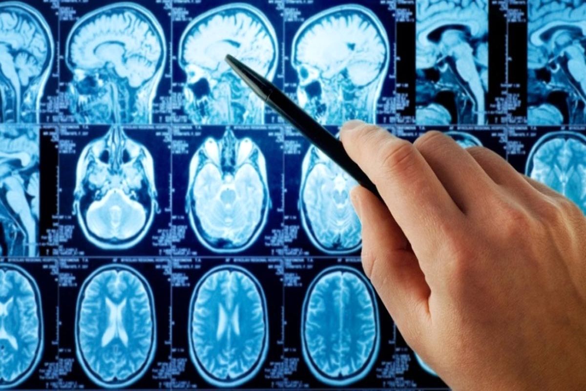 درمان سرطان مغز با ژل جدید و مخصوص