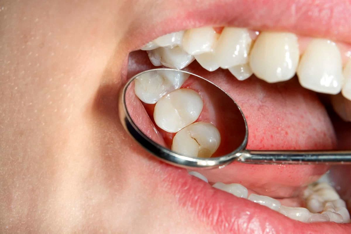 عامل اصلی خراب شدن دندان ها را بشناسید