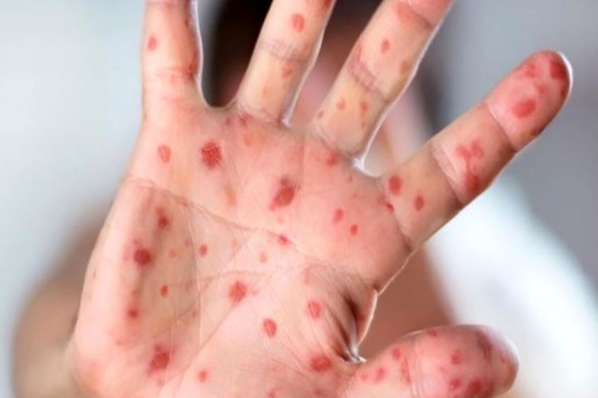 پویش واکسیناسیون سرخک و سرخجه در سیستان و بلوچستان آغاز شد