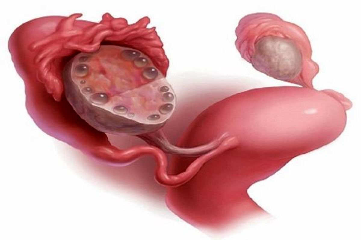 اثر کوئرستین روی التهاب، پارامترهای هورمونی و نتیجه بارداری زنان مبتلا به سندرم تخمدان پلی کیستیک