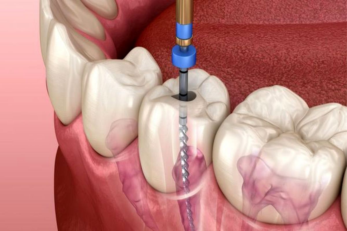 دندان عصب کشی شده تا چه مدت زنده می ماند؟