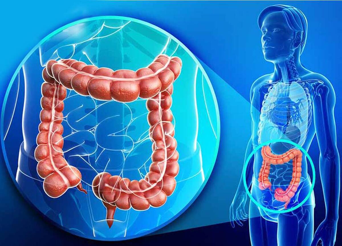 بررسی علل سرطان کولورکتال و روش‌های جلوگیری از عودت آن