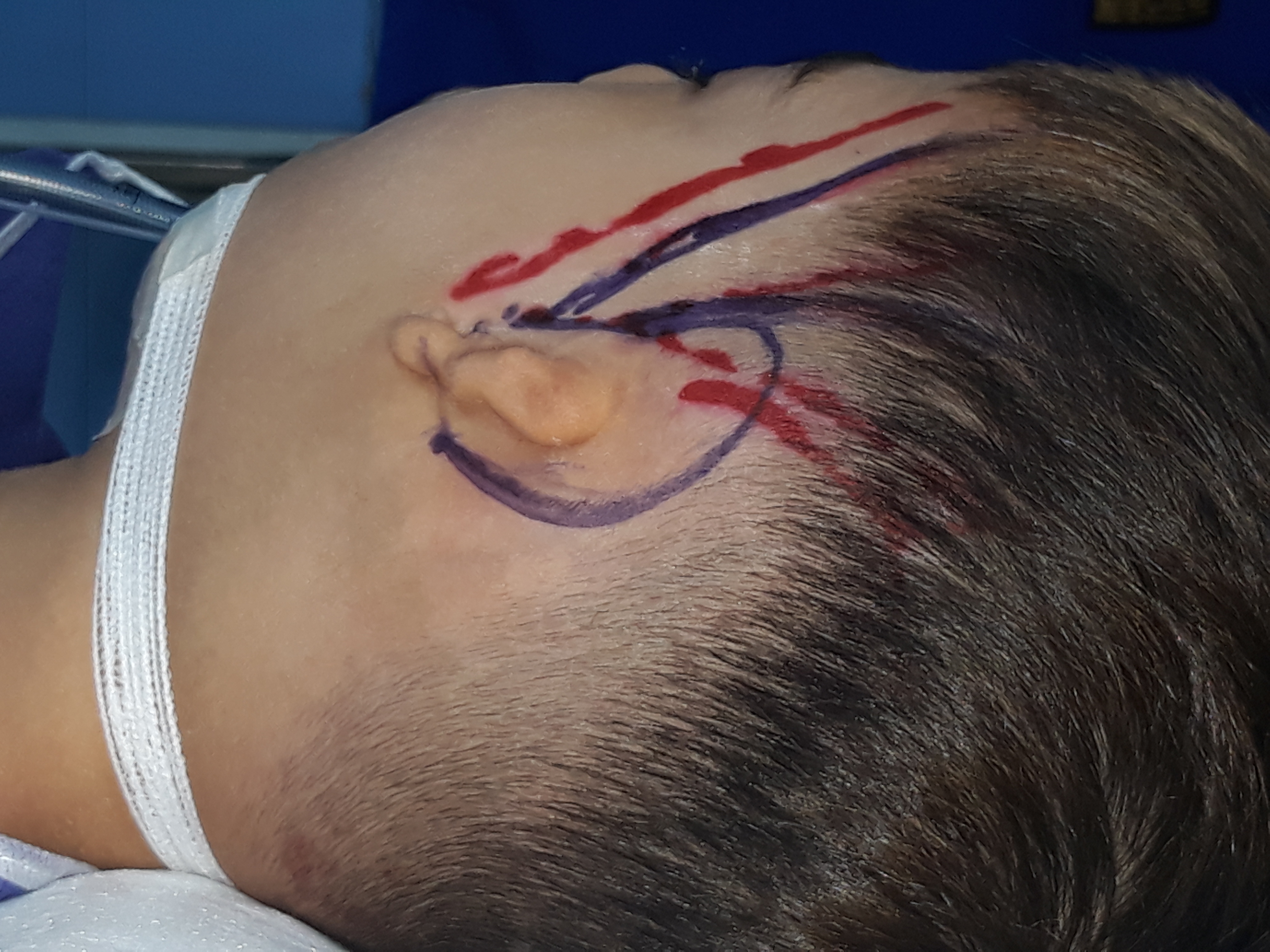 موفقیت در جراحی بازسازی لاله گوش؛ درمان ناهنجاری مادرزادی گوش بیرونی