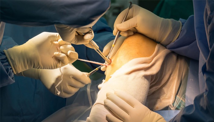 جراحی رباط صلیبی قدامی و بازسازی آن