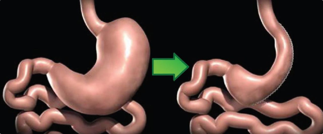 معرفی بهترین روش ‌های عمل لاغری