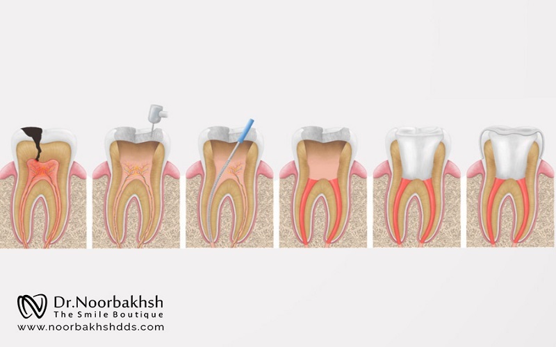 آیا جراحی دندان عقل و عصب‌کشی دندان ترسناک است؟
