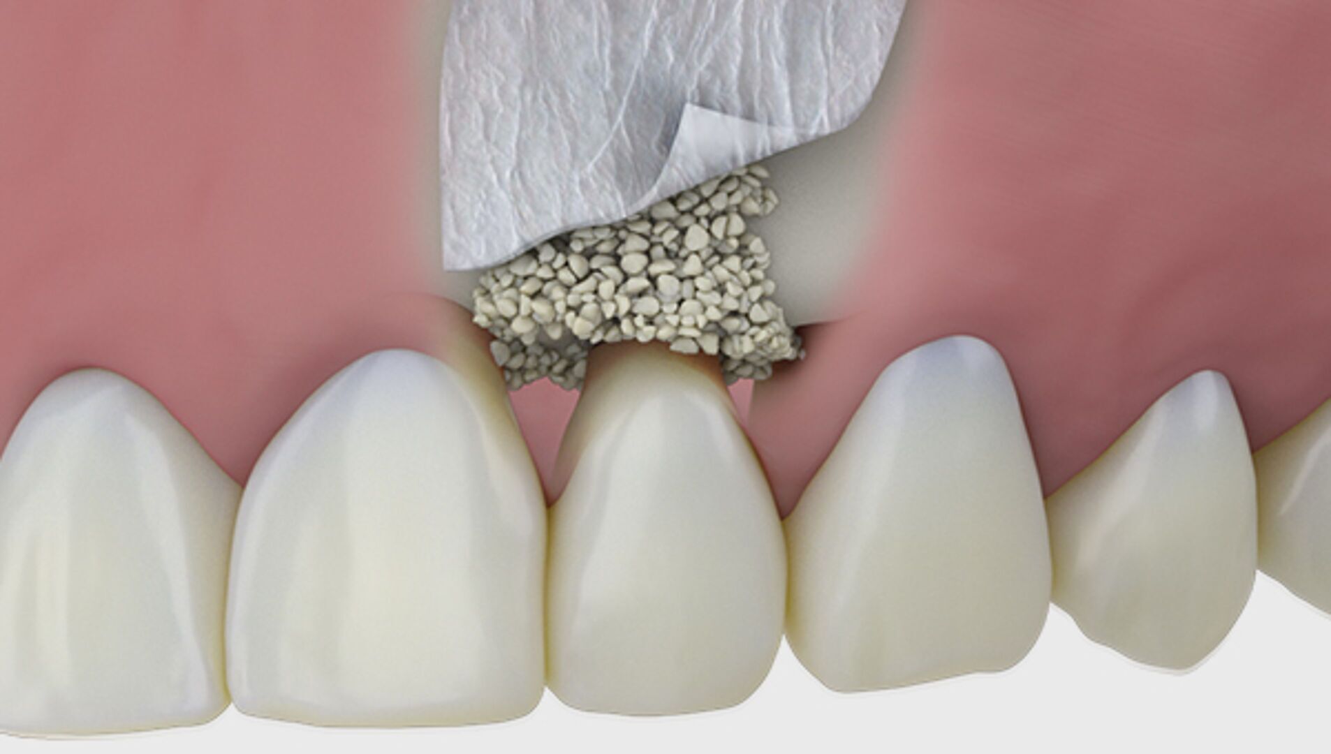 در چه صورت ایمپلنت نیاز به پودر استخوان دارد