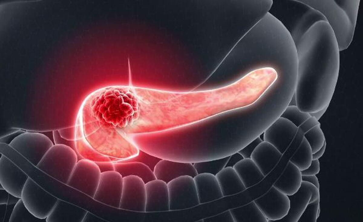  درمان سرطان پانکراس با کمک فناوری‌نانو ممکن می‌شود! 