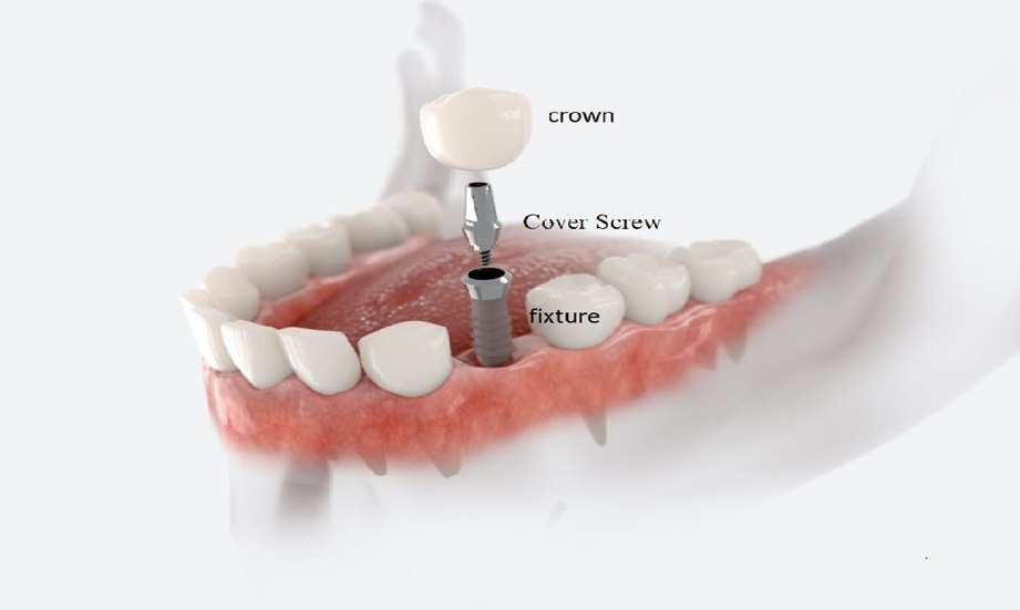 ایمپلنت دیجیتال مناسب چه کسانی است؟