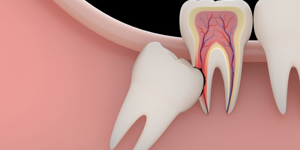 دندان عقل را بکشیم یا نه؟ دندان عقل را بکشیم یا نه؟