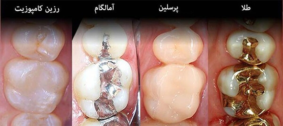 ترمیم دندان‌ با مواد همرنگ بهتر است یا غیرهمرنگ؟