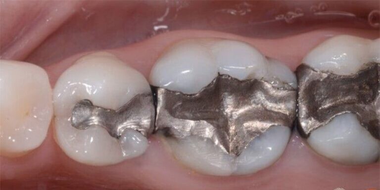 ترمیم دندان‌ با مواد همرنگ بهتر است یا غیرهمرنگ؟