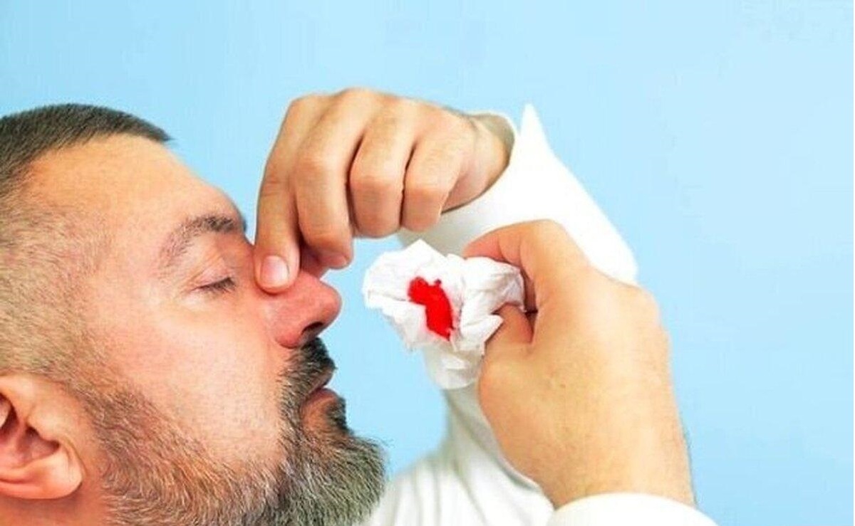 چند توصیه مهم درباره خونریزی بینی در گرما