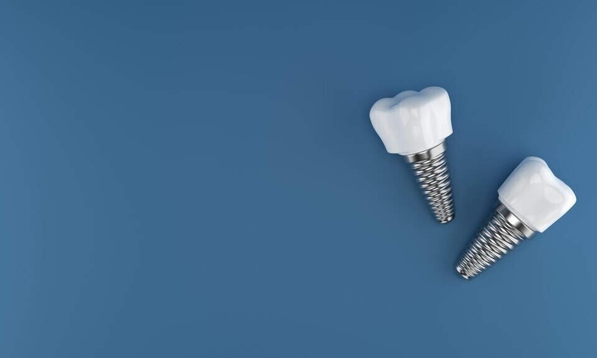 آیا عمر ایمپلنت دندان دائمی است؟