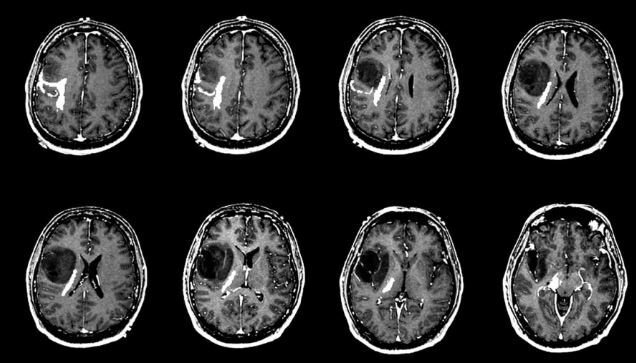 تشخیص به موقع سرطان مغز با روش نوری نوین