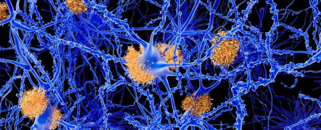 مسیر درمان آلزایمر تغییر می‌کند