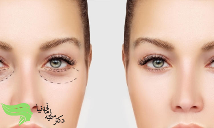 معرفی بهترین روش رفع افتادگی پلک