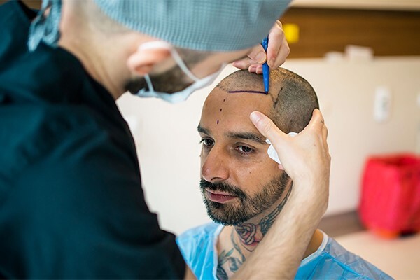 بهترین سن برای کاشت مو برای آقایان چه سنی است؟