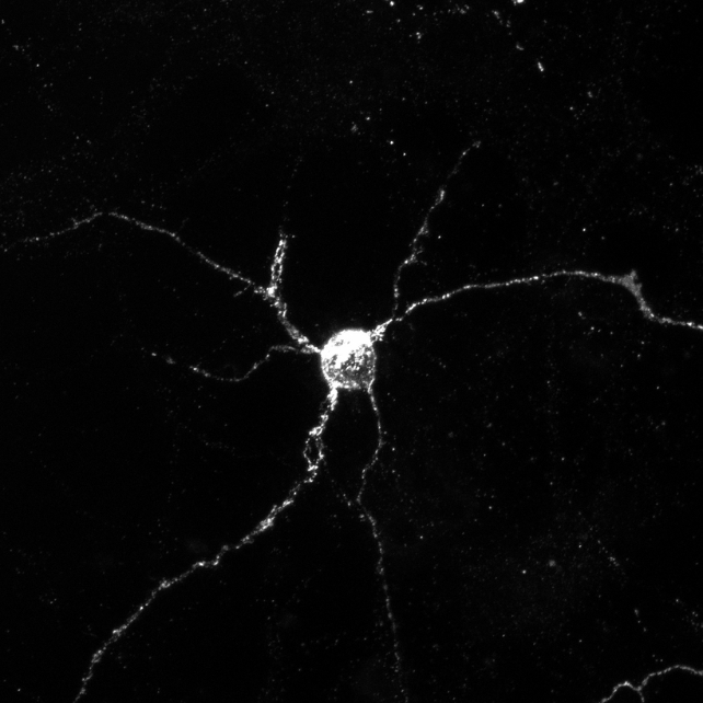 کشف درمانی نوین برای پارکینسون