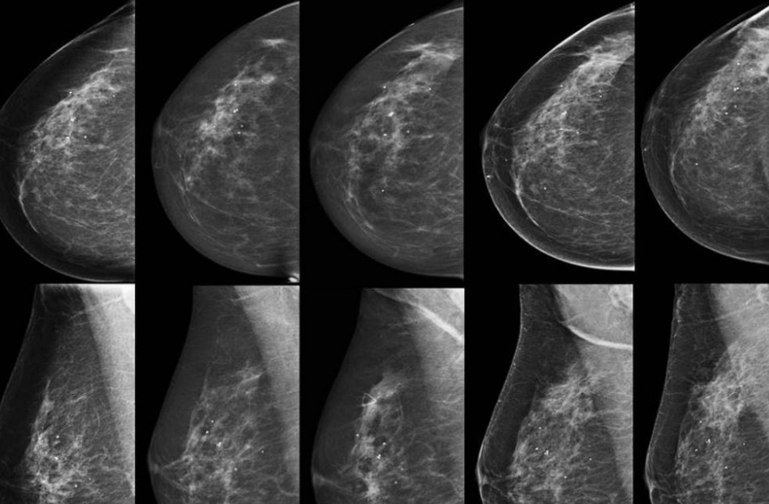 درد و رنج بیماران سرطان سینه و چالش های هزینه های سرسام آور تامین دارو
