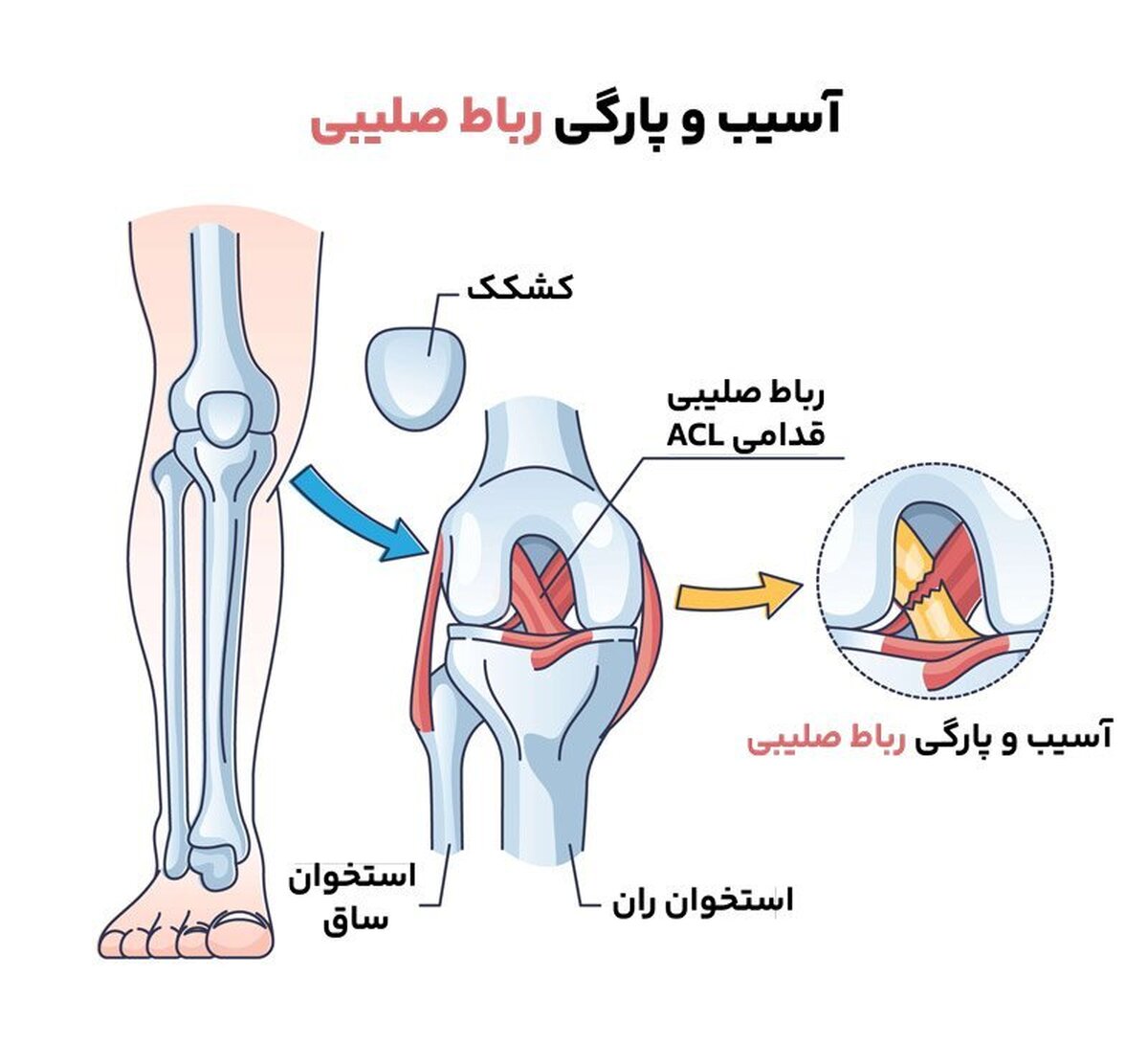 جراحی رباط صلیبی با پرده جفت جنین