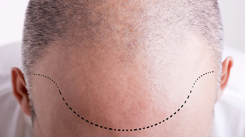 کاشت مو بدون دردسر با رعایت نکات طلایی مراقبتی