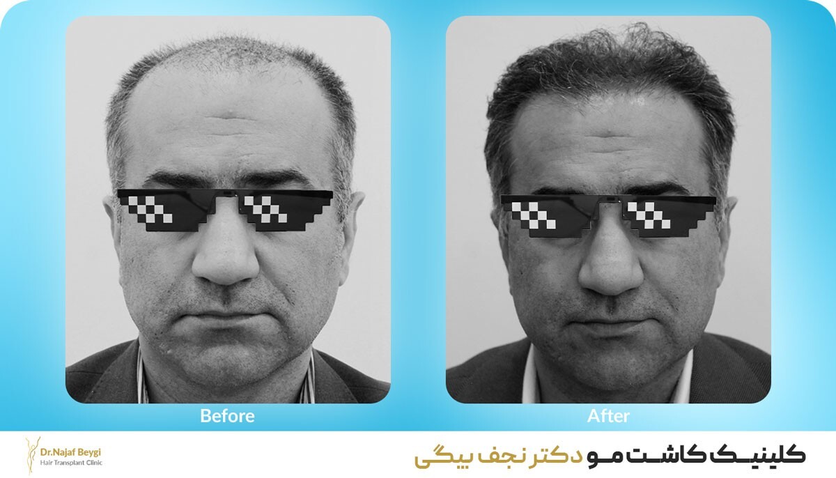 کاشت مو بدون دردسر با رعایت نکات طلایی مراقبتی