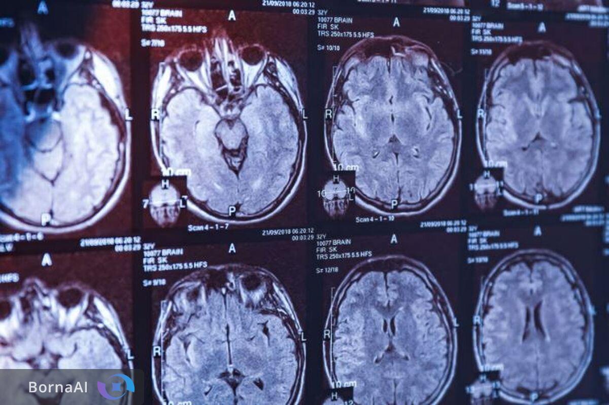 بومی‌سازی سلول‌درمانی برای درمان اختلال پارکینسون/ حمایت ۵ میلیارد تومانی از پژوهش‌های فناورانه حوزه علوم شناختی