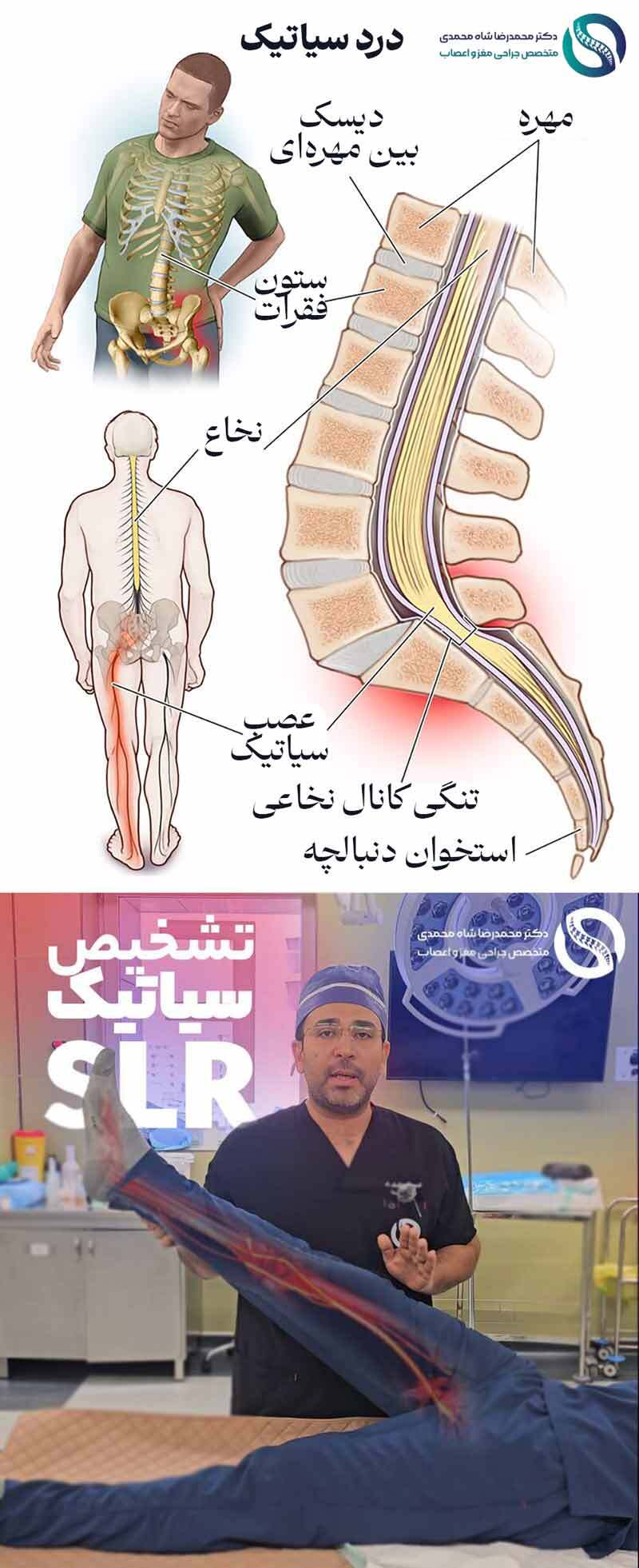 سیاتیک چیست؟ از علائم و علت درد سياتيك و بهترین روش درمان از نظر دکتر شاه محمدی