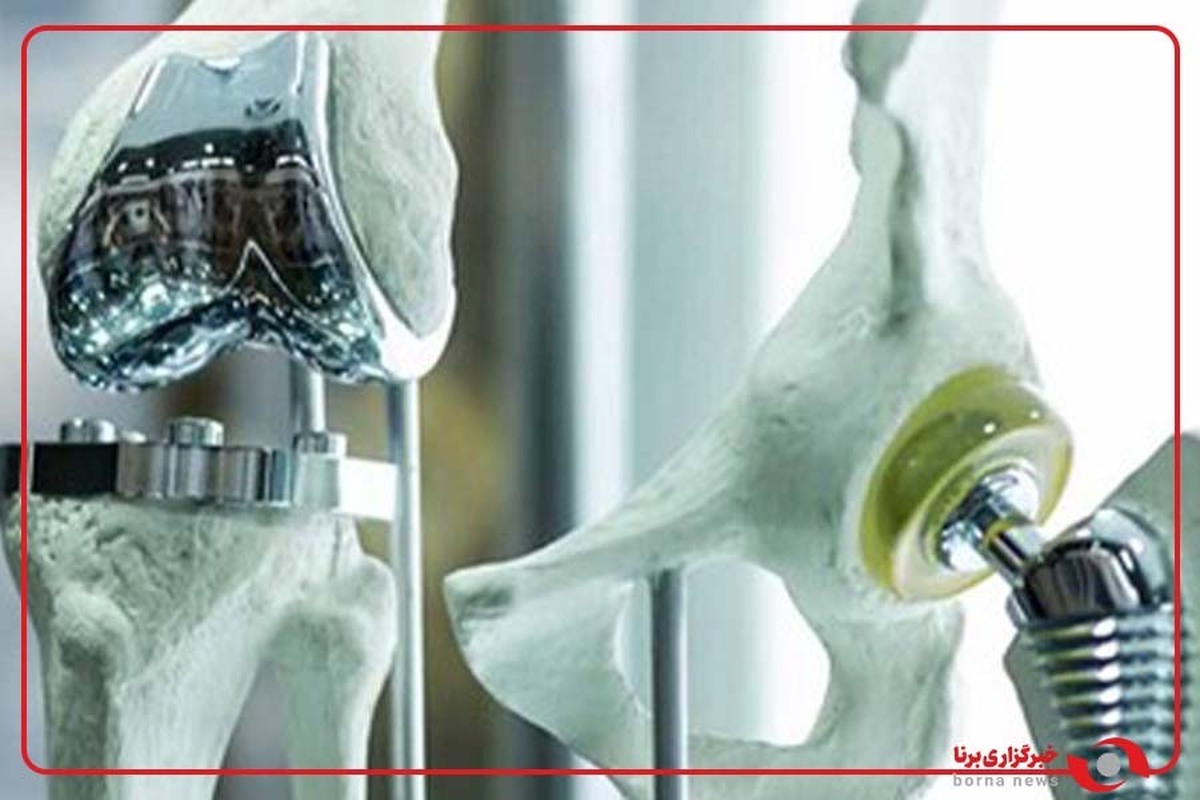 ایران تنها دارنده فناوری ایمپلنت