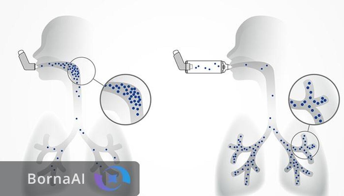 محصول جدید استنشاقی برای درمان سرطان ثبت اختراع شد