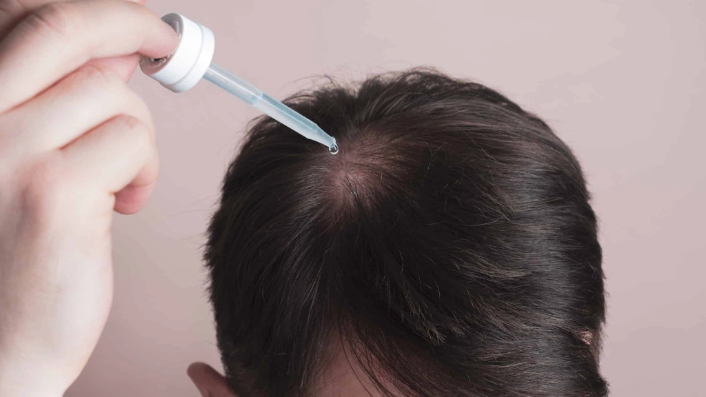 ریزش مو بعد از کاشت؛ طبیعی یا نگرانکننده؟ ریزش مو بعد از کاشت؛ طبیعی یا نگرانکننده؟