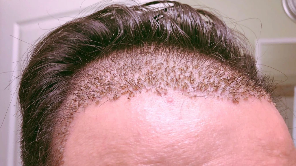 ریزش مو بعد از کاشت؛ طبیعی یا نگرانکننده؟ ریزش مو بعد از کاشت؛ طبیعی یا نگرانکننده؟