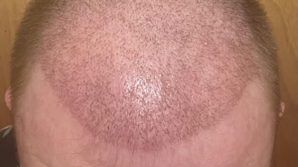 ریزش مو بعد از کاشت؛ طبیعی یا نگرانکننده؟ ریزش مو بعد از کاشت؛ طبیعی یا نگرانکننده؟