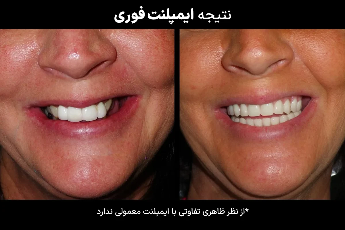 فرق ایمپلنت فوری و معمولی؛ حقایقی که دندانپزشکان کمتر درباره‌‌ شان حرف میزنند