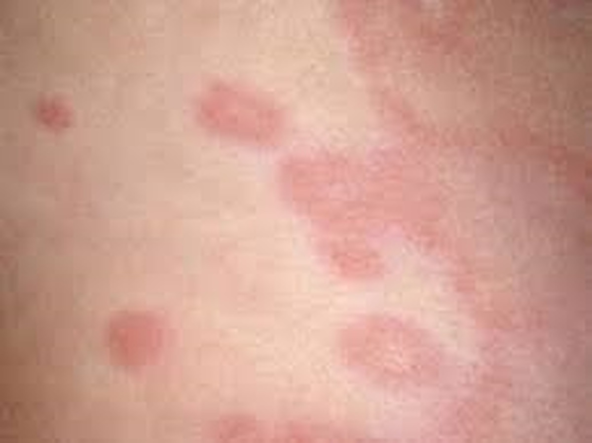 مصرف کورتون در درمان کهیر پوستی جایگاهی ندارد