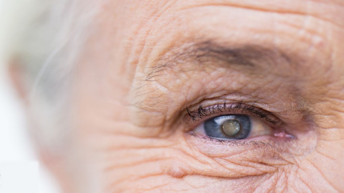 راه‌های پیشگیری از ابتلا به آب مروارید