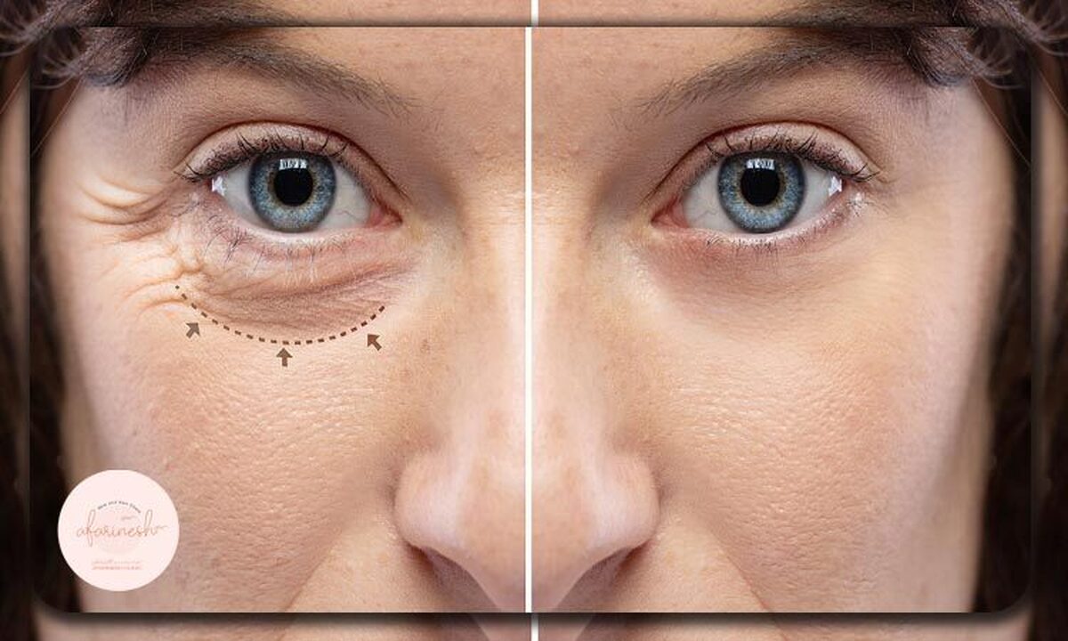 هزینه بلفاروپلاستی بدون جراحی در سال ۱۴۰۴ چقدر است؟