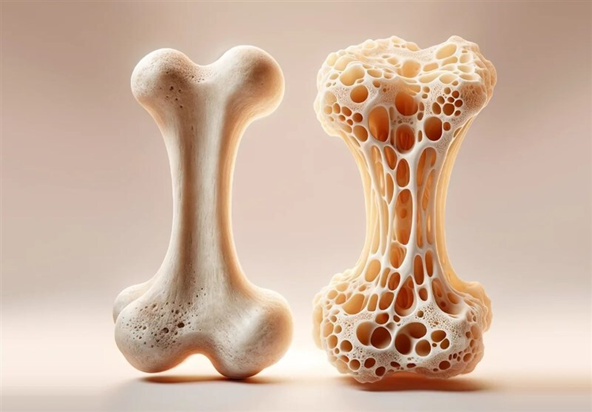 دلایل ابتلا به پوکی استخوان از نظر طب ایرانی