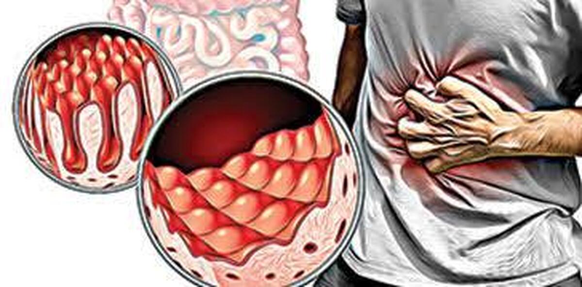 نقش رژیم غذایی در مدیریت بیماری سلیاک