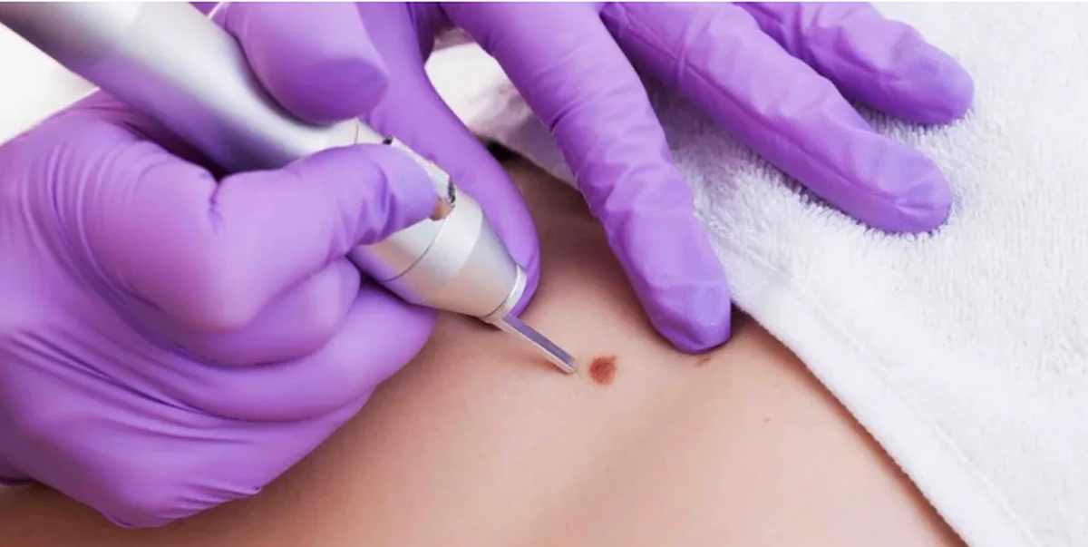 لیزر زگیل تناسلی، خداحافظی همیشگی با ویروس HPV