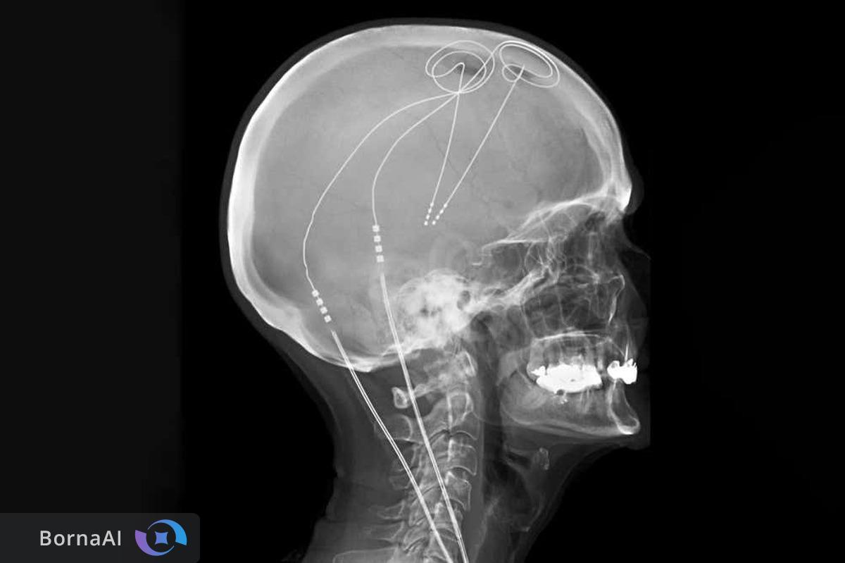 ایمپلنت مغزی شخصی‌سازی‌شده درد مزمن را نصف می‌کند!