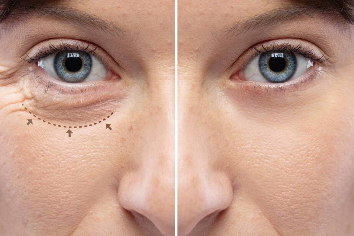 هزینه مزوتراپی زیر چشم در کلینیک های زیبایی تهران ۱۴۰۴